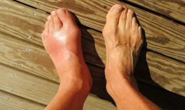 داء المـلوك وعـيد الأضحى الُمبـارك ؟