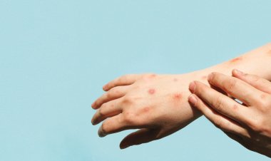 مرجعك لكل ماتريد معرفتة عن الجدري المائي ( العنقز)
