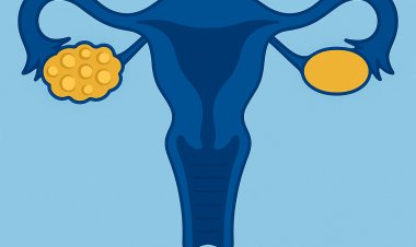 ما هو تكيس المبايض؟ شرح طبي دقيق لكل ما تحتاجين معرفته